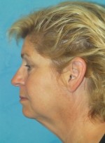 Facelift (Rhytidectomy)