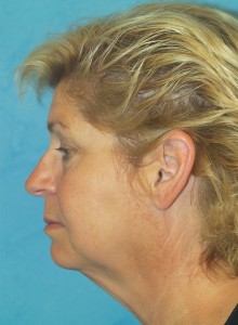 Facelift (Rhytidectomy)