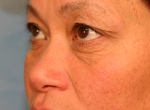 Upper Eye Lift (Blepharoplasty) Photos