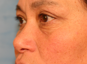 Upper Eye Lift (Blepharoplasty)