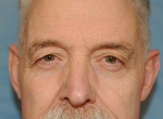 Upper Eye Lift (Blepharoplasty) Photos