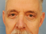 Upper Eye Lift (Blepharoplasty) Photos