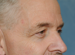 Upper Eye Lift (Blepharoplasty) Photos