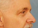 Upper Eye Lift (Blepharoplasty) Photos