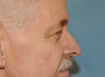 Upper Eye Lift (Blepharoplasty) Photos