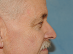 Upper Eye Lift (Blepharoplasty)