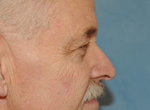 Upper Eye Lift (Blepharoplasty) Photos