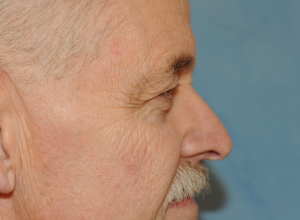 Upper Eye Lift (Blepharoplasty)