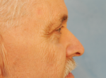 Upper Eye Lift (Blepharoplasty) Photos