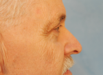 Upper Eye Lift (Blepharoplasty)