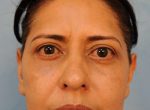 Upper and Lower Eye Lift (Blepharoplasty)