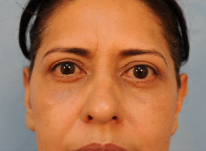 Upper and Lower Eye Lift (Blepharoplasty)