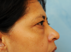 Upper and Lower Eye Lift (Blepharoplasty)