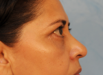 Upper and Lower Eye Lift (Blepharoplasty)