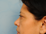 Upper and Lower Eye Lift (Blepharoplasty)