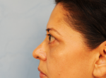 Upper and Lower Eye Lift (Blepharoplasty)