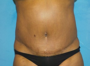 Tummy Tuck (Abdominoplasty)