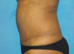 Tummy Tuck (Abdominoplasty)