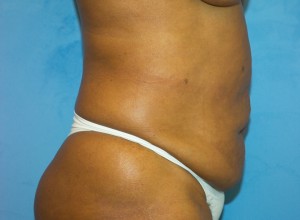 Tummy Tuck (Abdominoplasty)