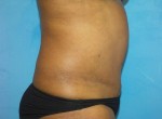 Tummy Tuck (Abdominoplasty)