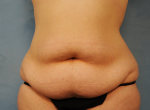 Tummy Tuck (Abdominoplasty)