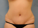 Tummy Tuck (Abdominoplasty)