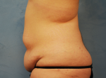 Tummy Tuck (Abdominoplasty)