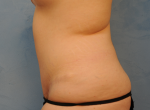 Tummy Tuck (Abdominoplasty)