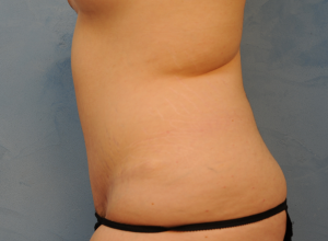 Tummy Tuck (Abdominoplasty)