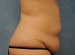 Tummy Tuck (Abdominoplasty)