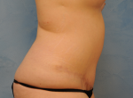 Tummy Tuck (Abdominoplasty)