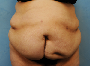 Tummy Tuck (Abdominoplasty)