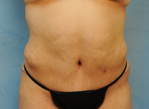 Tummy Tuck (Abdominoplasty)