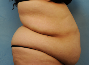 Tummy Tuck (Abdominoplasty)