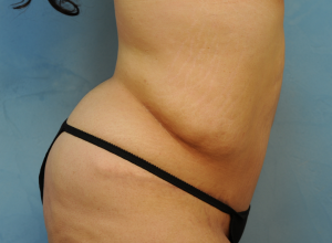 Tummy Tuck (Abdominoplasty)