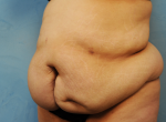 Tummy Tuck (Abdominoplasty)