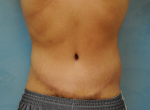 Circumferential Body Lift