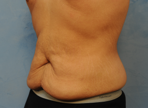 Circumferential Body Lift