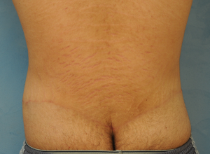 Circumferential Body Lift