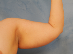 Arm Lift (Brachioplasty)