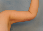 Arm Lift (Brachioplasty)