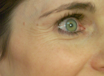 Injectables (Botox, Juvederm)