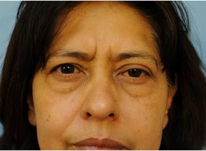 Upper Eye Lift (Blepharoplasty)