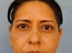 Upper Eye Lift (Blepharoplasty)