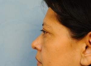 Upper Eye Lift (Blepharoplasty)