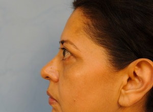 Upper Eye Lift (Blepharoplasty)