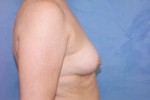 Silicone Breast Augmentation (Augmentation Mammoplasty)
