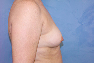Silicone Breast Augmentation (Augmentation Mammoplasty)
