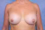 Silicone Breast Augmentation (Augmentation Mammoplasty)