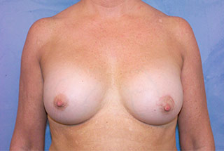 Silicone Breast Augmentation (Augmentation Mammoplasty)